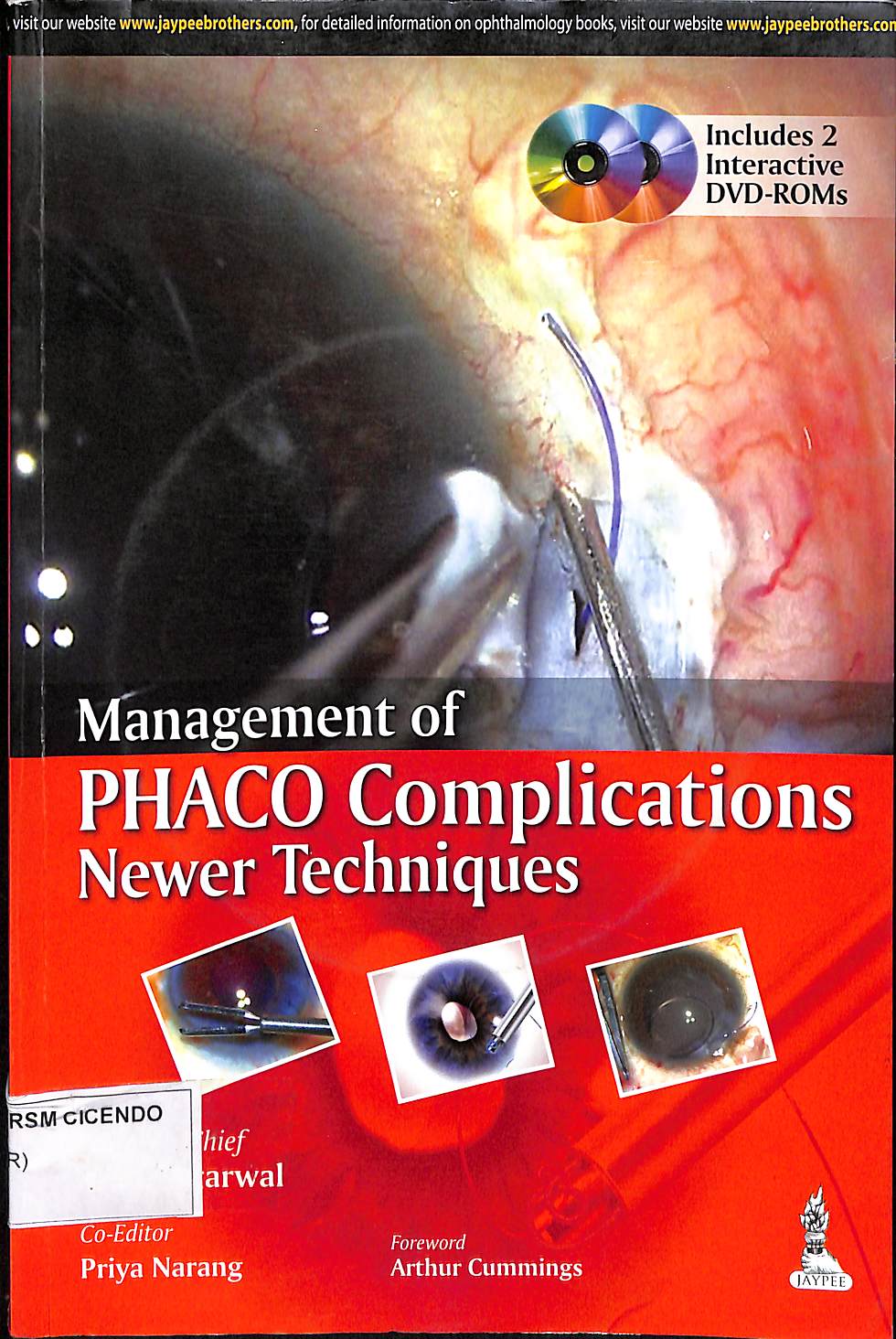 management of phaco complications newer techniques