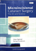 microincisional cataract surgery, the art and science