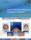 small incision manual cataract surgery, mini nuc and fluidics phacosection and viscoexpression