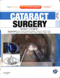 cataract surgery