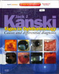 jack j kanski sign in ophthalmology causes and differential diagnosis