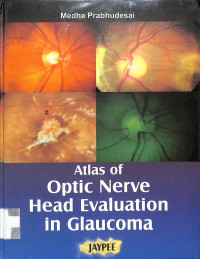 atlas of optic nerve head evaluation in glaucoma