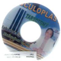 Oculoplasty tarsonomy